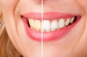 A Plus Dental | Teeth Whitening | Dentist Campbelltown