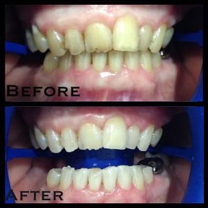 Philiips Zoom Whitening Before and After 2 | Dentist Campbelltown