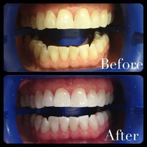 Philiips Zoom Whitening Before and After | Dentist Campbelltown