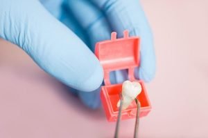 Wisdom Tooth Extraction | Dentist Campbelltown