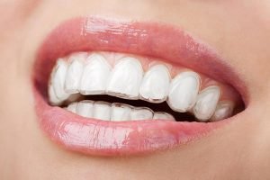 A Plus Dental | Invisalign | Dentist Campbelltown