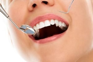 A Plus Dental | White Fillings | Dentist Campbelltown