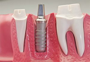 Dental Implants | Dentist Campbelltown