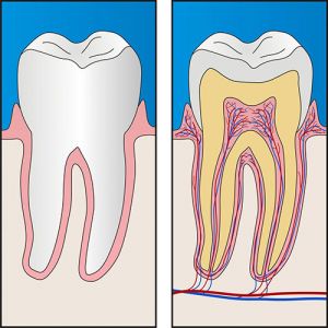 Root Canal Theraphy | Dentist Campbelltown