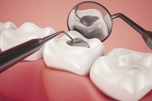 A Plus Dental | Lost Damaged Fillings, Crown Or Inlay Onlay | Dentist Campbelltown