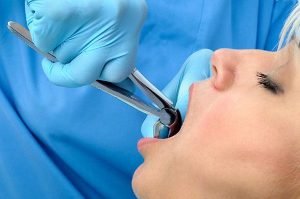 A Plus Dental | Tooth Extraction | Dentist Campbelltown