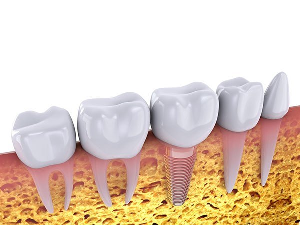 Dental Implants And Missing Teeth A Plus Dental 1763