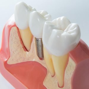 Bone Grafting | Dentist Campbelltown