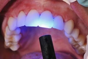 Dental Bonding | Dentist Campbelltown