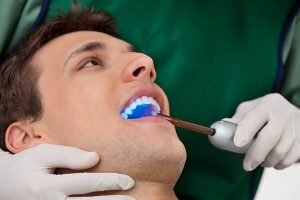 Dental Sealants | Dentist Campbelltown