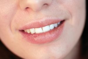 Dry Mouth Treatment | Dentist Campbelltown