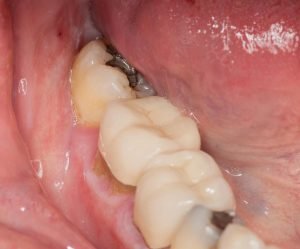 Lost and Damaged Fillings What to Do