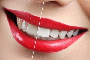 Campbelltown Dentist tips on Brightening your Teeth