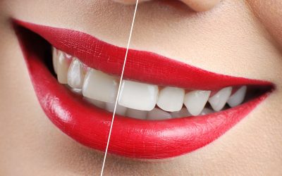 Dental tips on Brightening your Teeth