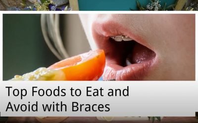 Top Foods to Eat and Avoid with Braces from A Plus Dental