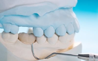 How Long Will Dental Crowns Last? Answers from A Plus Dental