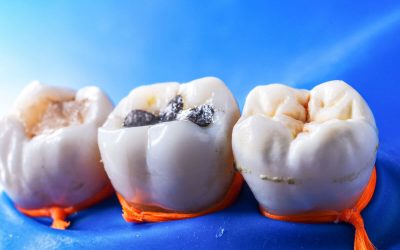 Choosing the Best Type of Dental Fillings in Campbelltown