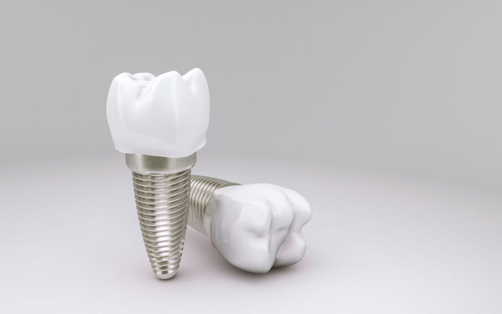 top 6 reasons dental implants are worth the investment