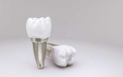 Top 6 Reasons Dental Implants are Worth the Investment