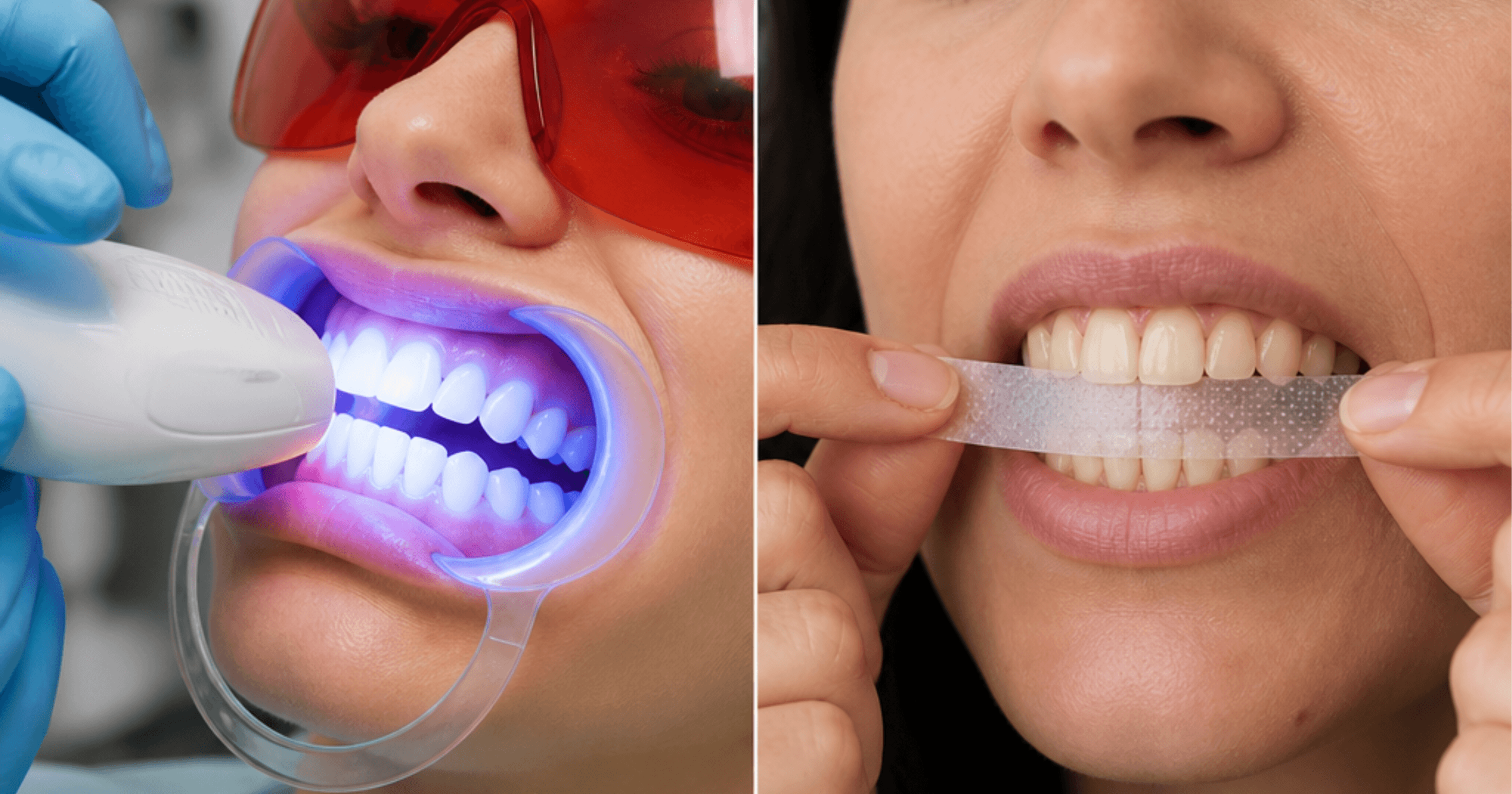 Comparison of professional teeth whitening versus DIY whitening strips