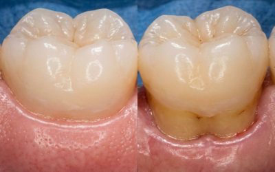 Gum Recession: What Causes It and How It’s Treated